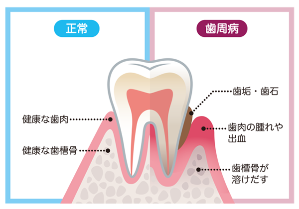 歯周病は重症化しても痛みが出ない場合があります