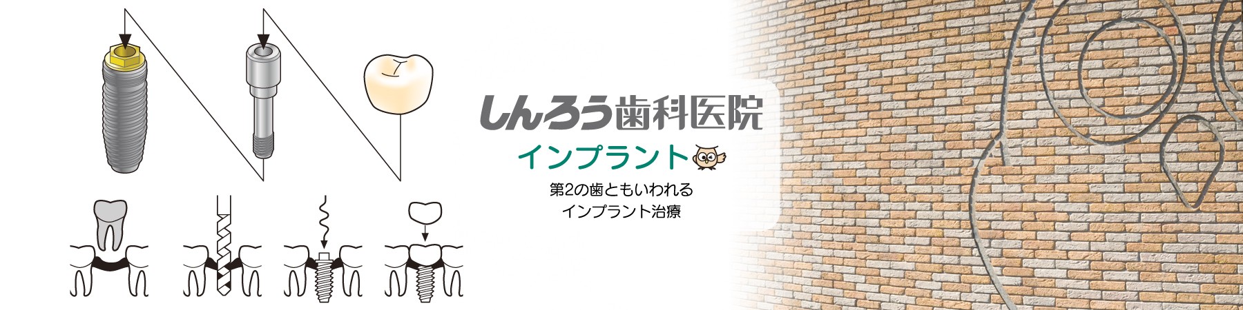 早期の機能回復を見据えた手術プランを提案しています