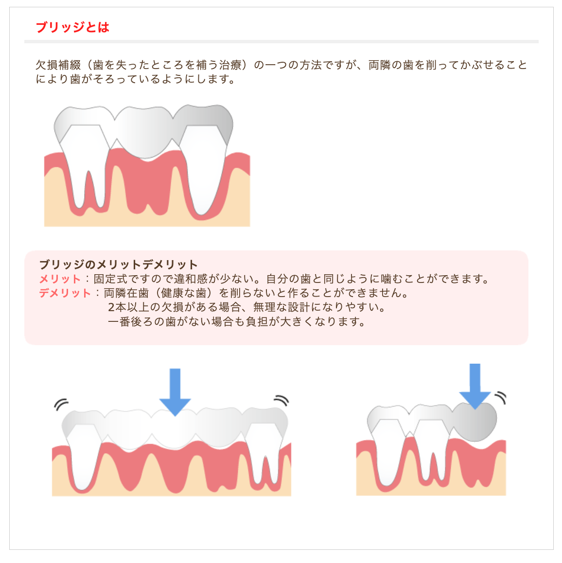 歯を失った患者様に適したブリッジや入れ歯の治療を提供しています