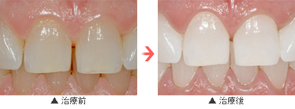 白く輝く歯で印象をアップ