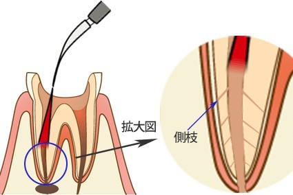 レーザーによる根管治療