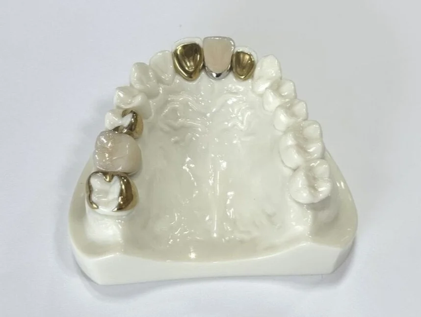 ヒューマンブリッジを通じて、患者様の負担に配慮した補綴治療が提供されています