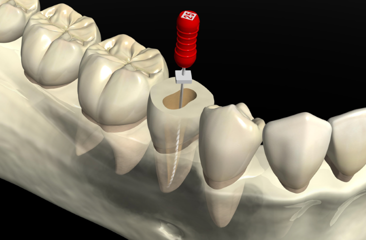 再発を許さないラバーダム防湿のこだわり