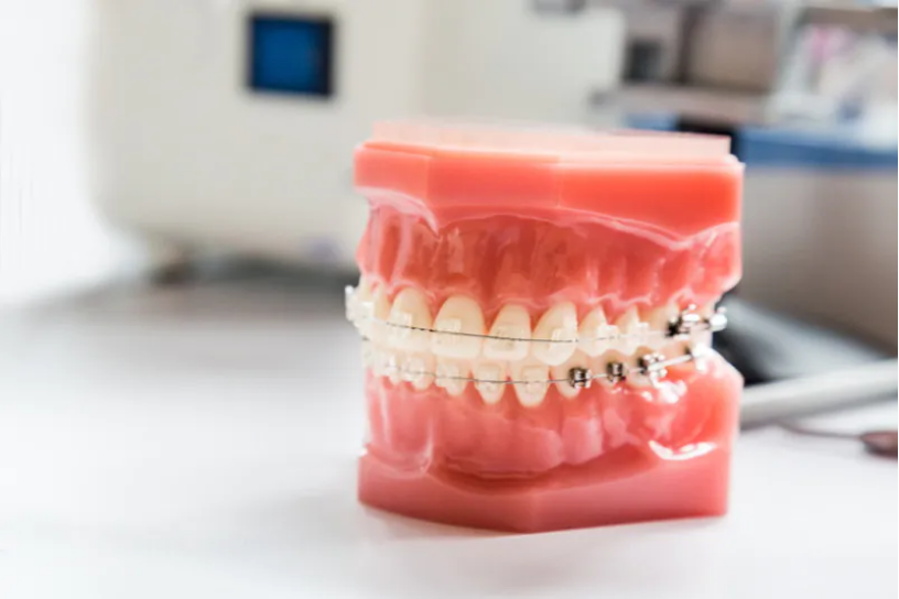 目立ちにくい白いブラケット・ホワイトワイヤーもあります