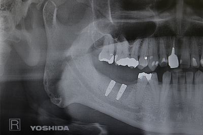 デジタルレントゲンシステム