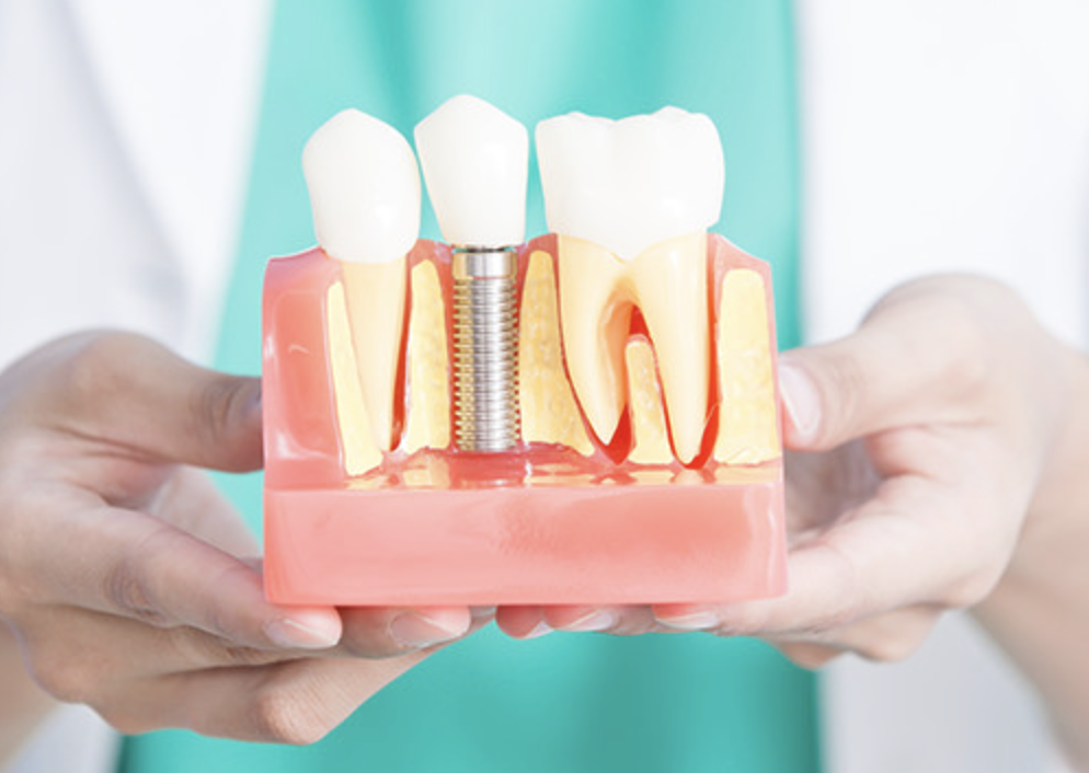 失った歯を補う治療の一つとして、インプラント治療を行っています