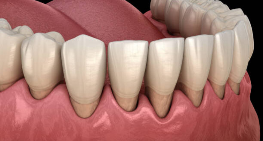 再感染を防止するためにはプラークコントロールが重要