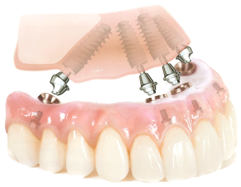 オールオン4という即日インプラントを目指した治療法がございます