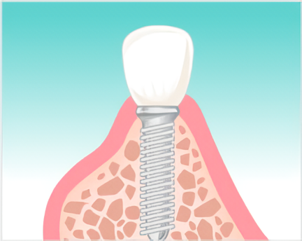 インプラントは、入れ歯では満足できなかった方や、よりしっかり噛める状態を求める方に最適な治療法です。