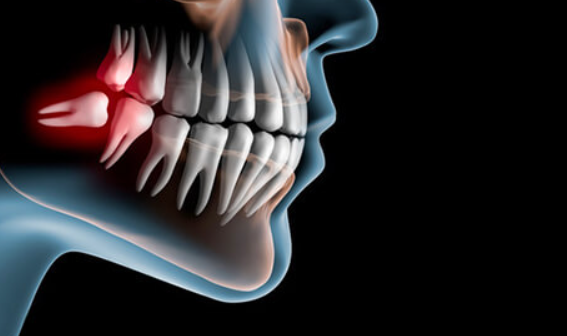 親知らずの抜歯もおまかせください