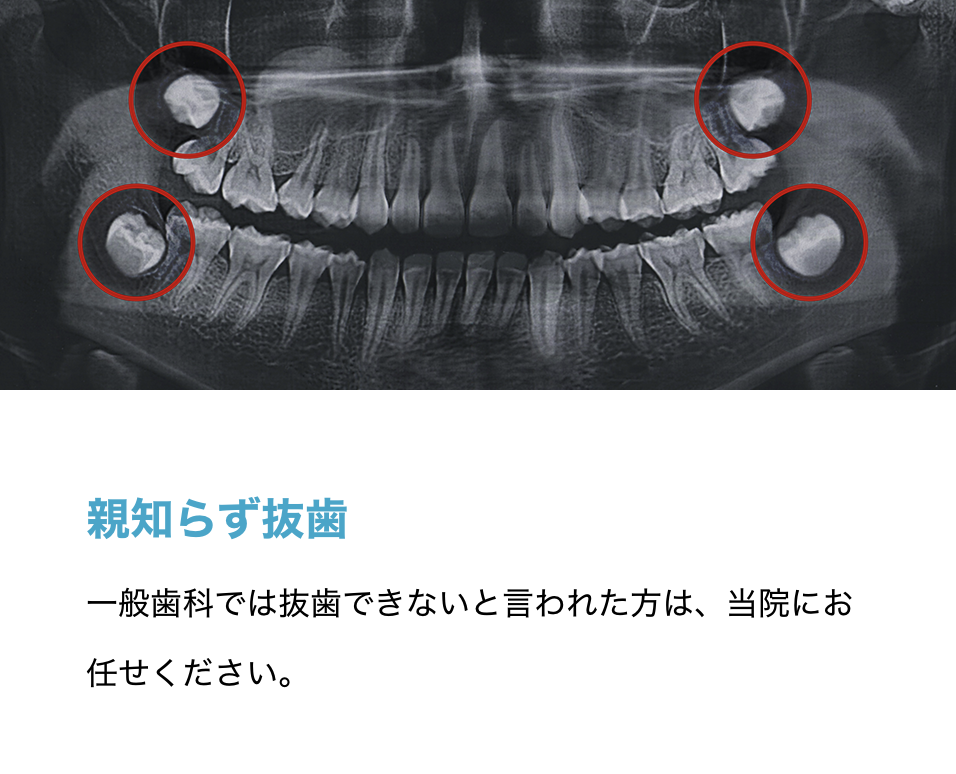 親知らずの抜歯を必要とされる患者様に、専門的な治療を提供しています