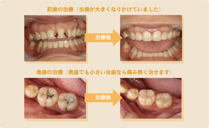 削らない治療を基本に歯の寿命を延ばすよう努めています