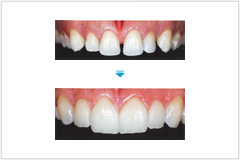 オフィスホワイトニングも対応しております