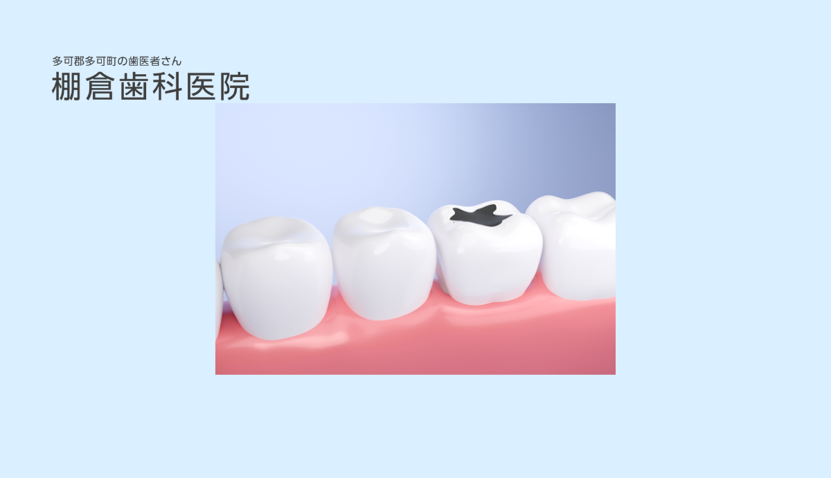 レーザー処置で低侵襲な治療と安心の抜歯対応