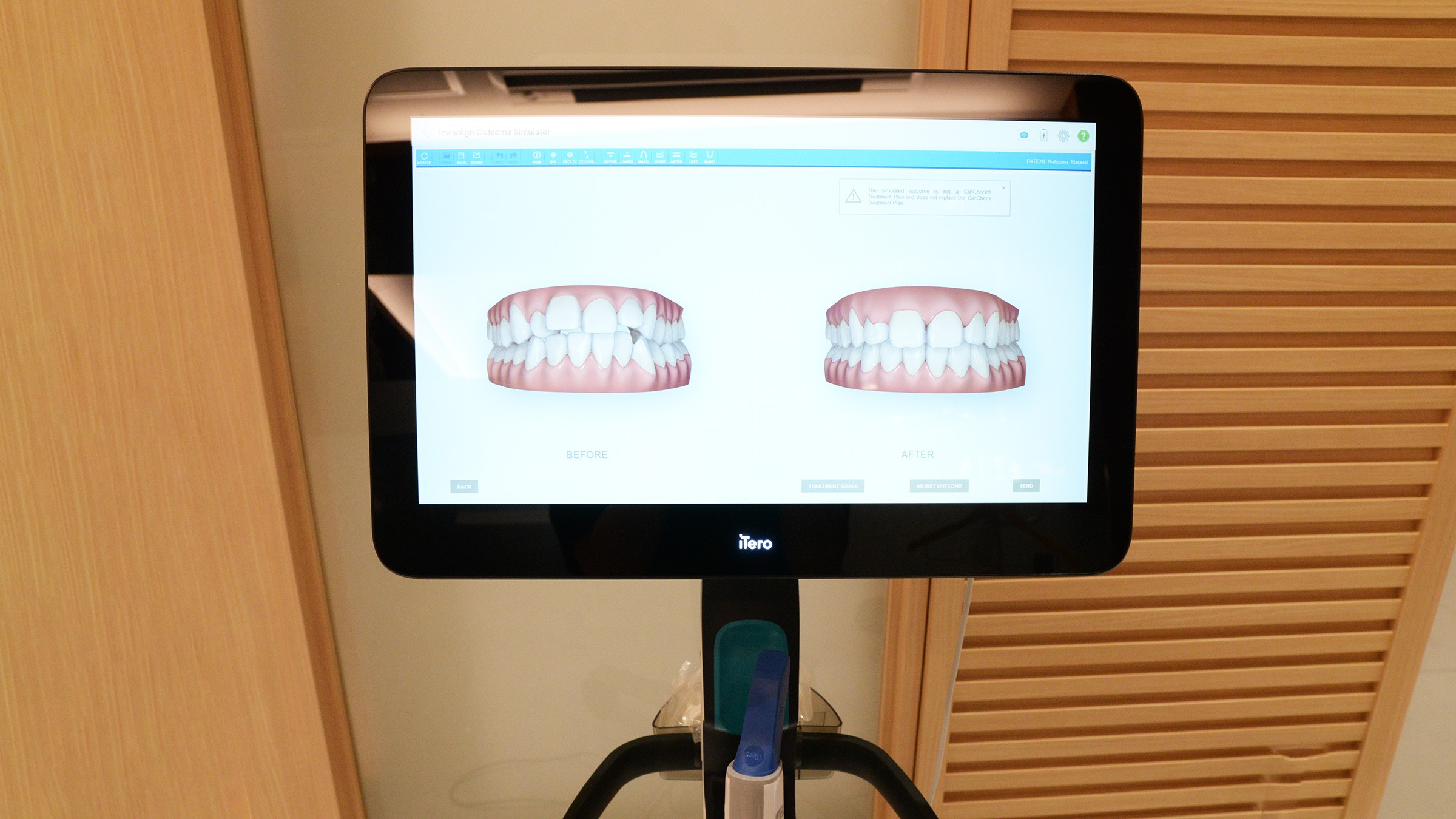 3D光学スキャナー iTeroによりお口の中を瞬時にスキャンします