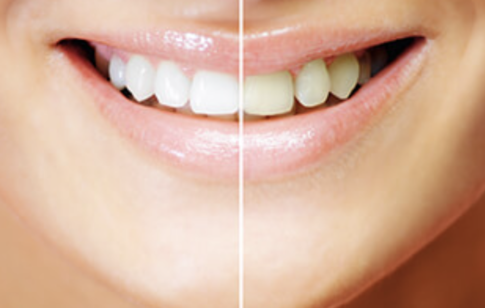 ホワイトニングは患者様の求める白さを追求します