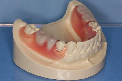 ノンメタル義歯