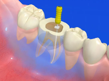 患者様の歯をできる限り守り、健康を長期的に維持できるよう、丁寧で効果的な根管治療を行っています。