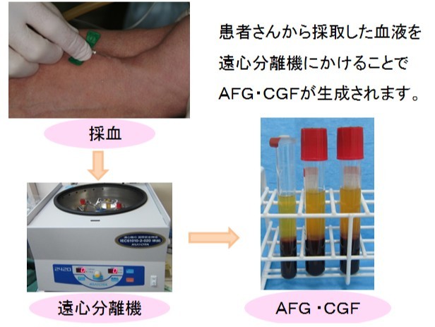 患者様自身の血液から生成したAFGとCGFを再生療法に応用しています