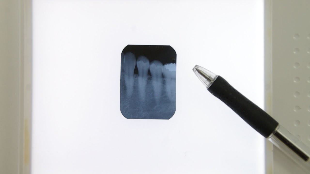 予防がもっとも大切です