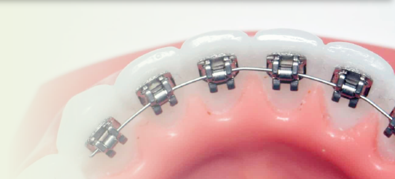 気になる部分だけを整える「部分矯正（プチ矯正）」をご提供しています