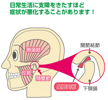 顎関節症改善