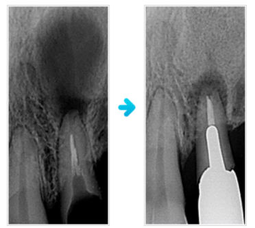 しんこう歯科での根幹治療写真の例