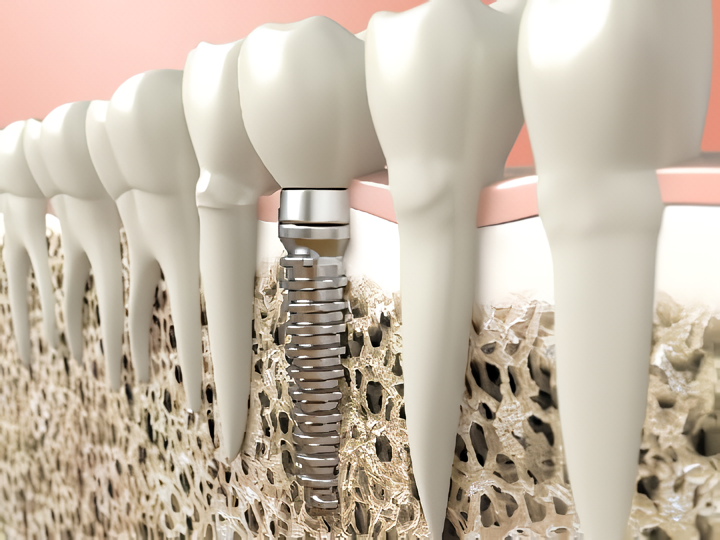 噛める喜びを取り戻す