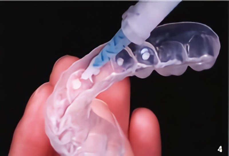 ホームホワイトニングを実施しています