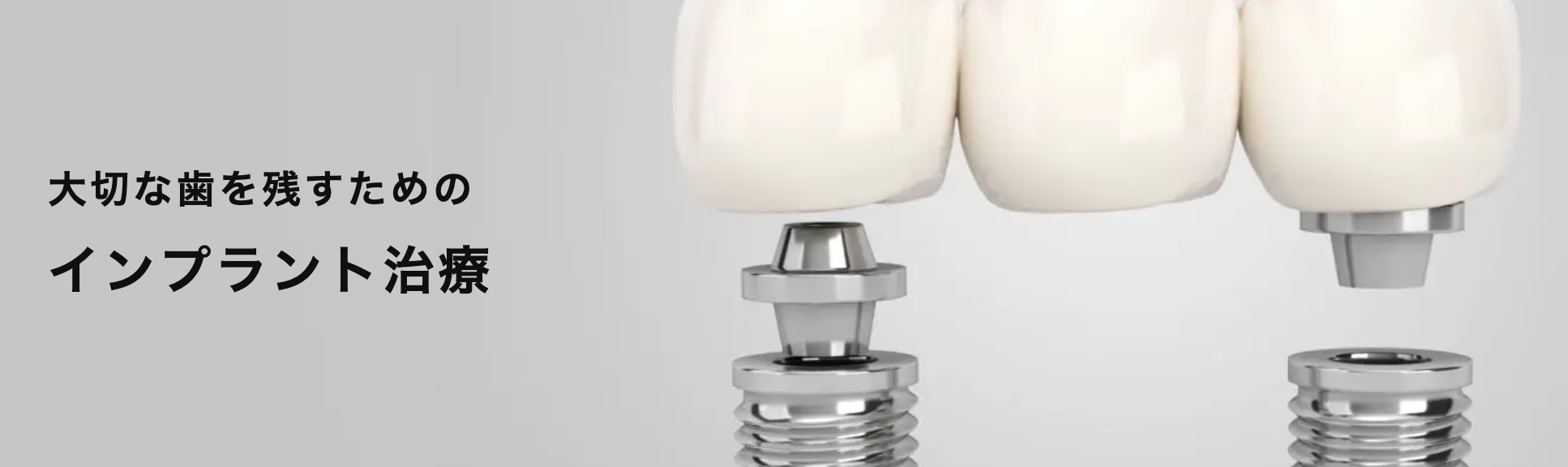 歯を失った際の選択肢として、インプラント治療を提供しています