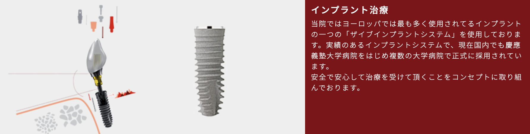 実績豊富な「ザイブインプラントシステム」を用いたインプラント治療を行っています