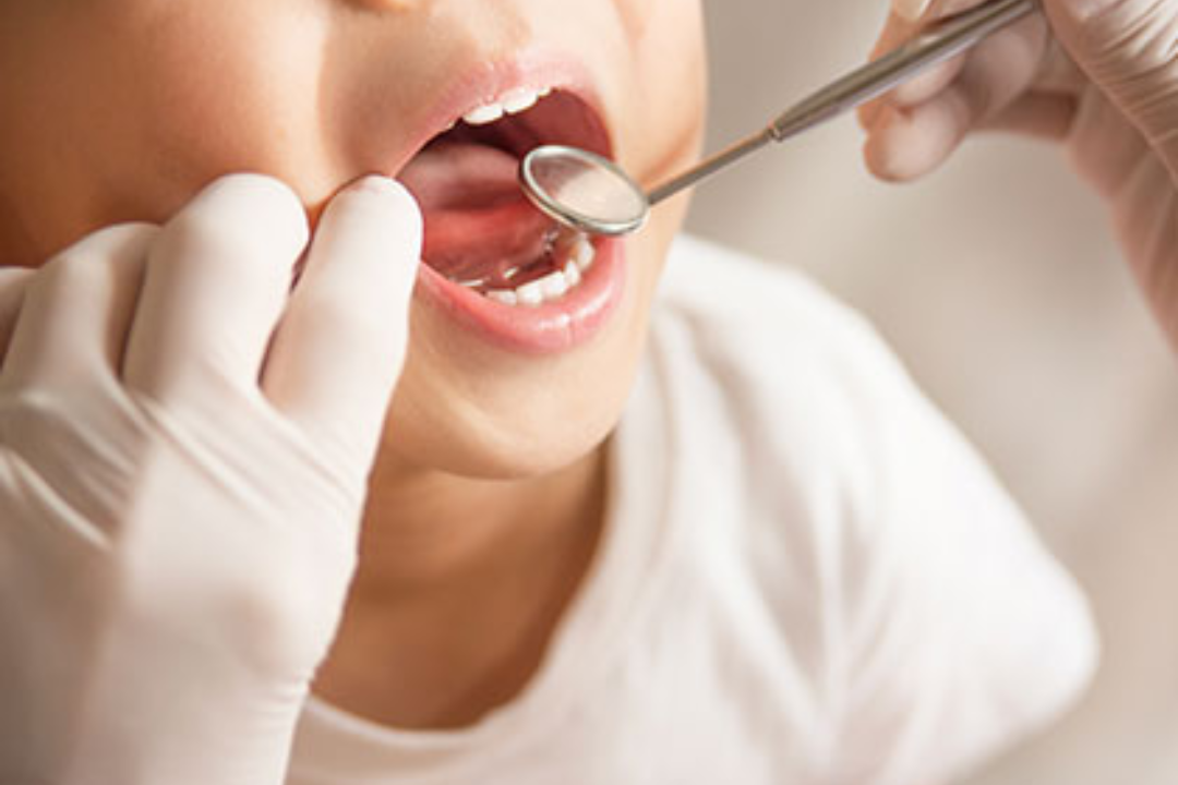 なるべく削らないお子様の虫歯治療