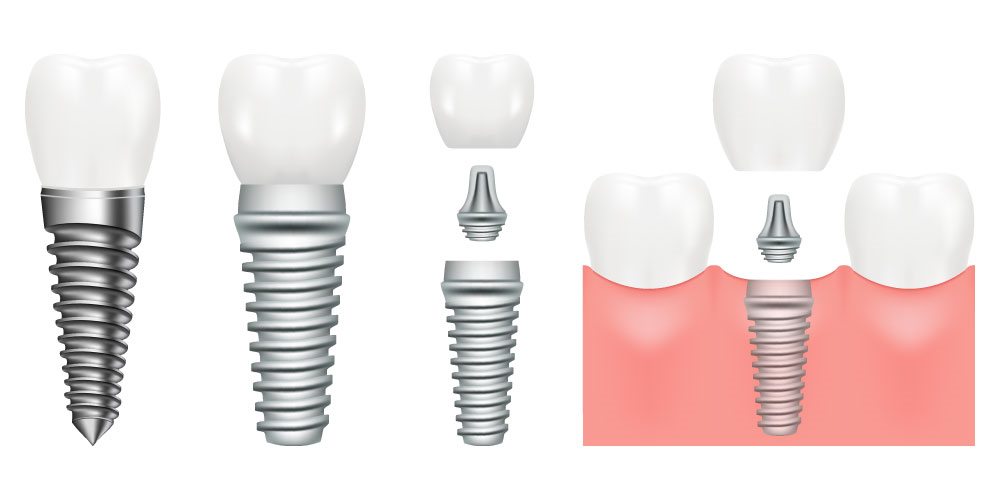 インプラント治療