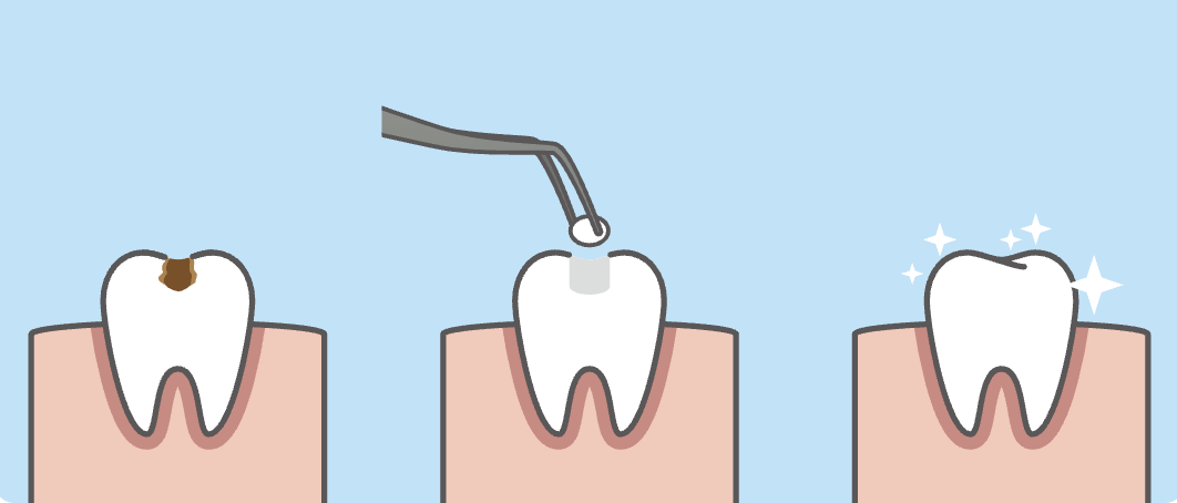 患者様の歯をできるだけ長く健康に保つための治療を提供しています