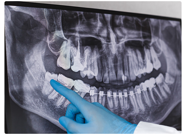 親知らずの生え方により、抜歯をおすすめしています