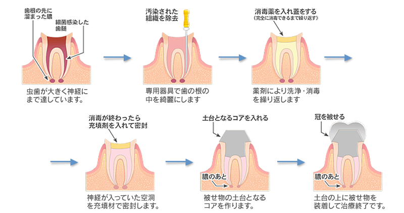 徹底的な根管治療をおこないます