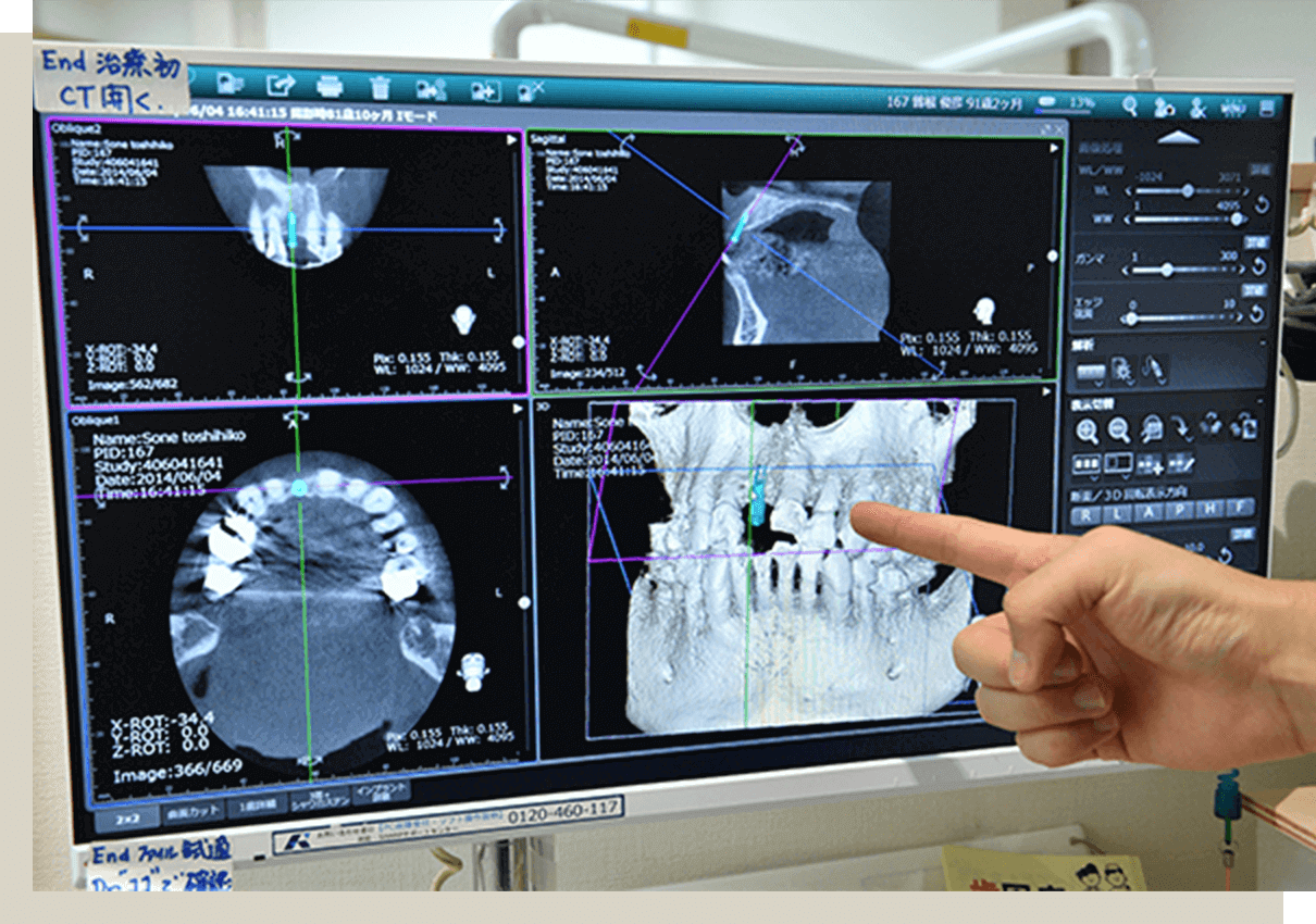 インプラント埋入前に歯科用CTを活用し、骨や神経の位置を精密に診断します