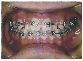 笑顔と健康を整える矯正治療