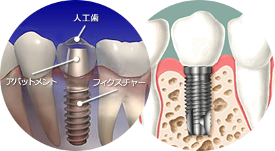 自然な噛み心地を取り戻すインプラント治療への取り組み