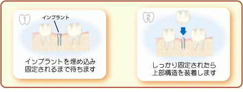 いわま歯科クリニックが提案するインプラントでの新しい歯科治療
