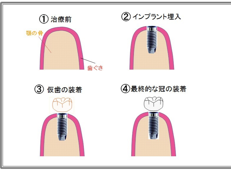 安全性と精度を重視したインプラント治療を提供しています
