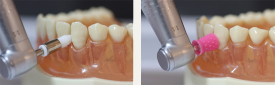 ペーストによる歯面のコーティング