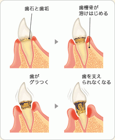 重症化しないように、定期メンテナンスを行いましょう