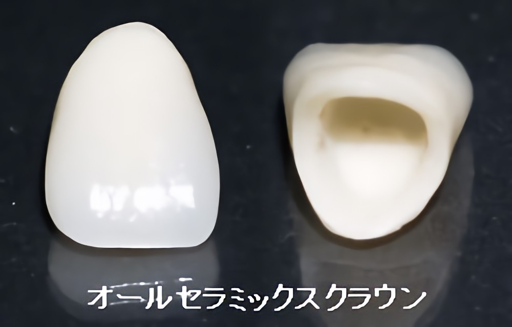 オールセラミックスクラウン