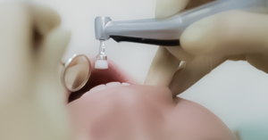 細菌の数を減らし、歯周病や虫歯を予防する