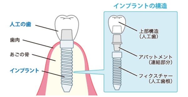 人工歯根を埋め込み、しっかりとした噛み心地を得ることができます