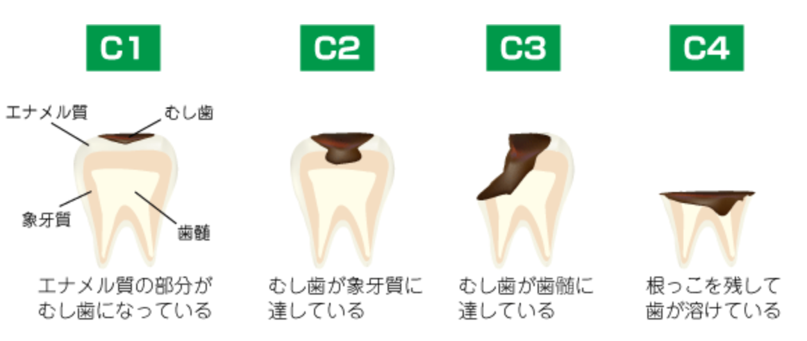 むし歯にならないためにも、歯磨きをしっかりと行いましょう