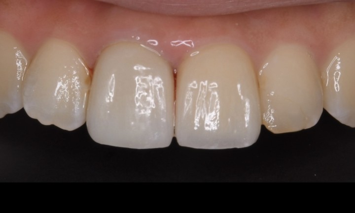 ラミネートベニアとセラミッククラウン