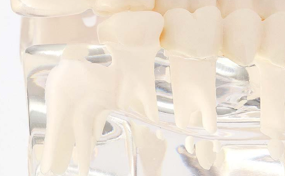 3D画像診断技術を活用した親知らずの抜歯と口腔疾患の専門的ケア