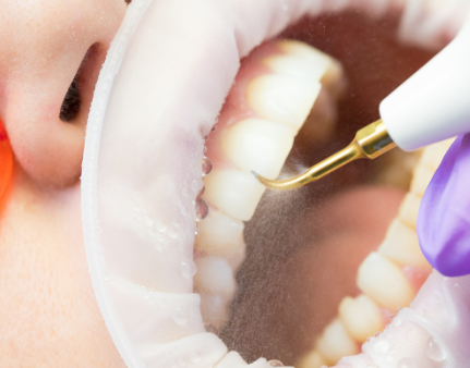 患者様一人ひとりの状態に応じて最適な治療プランを提案し、歯周病の予防と改善に取り組んでいます。